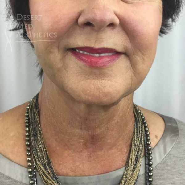 After full face threads front view case 3