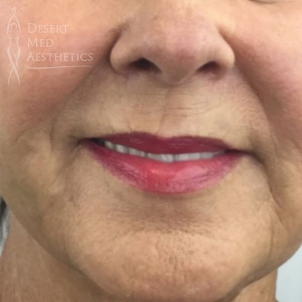 After full face threads front view closeup case 3