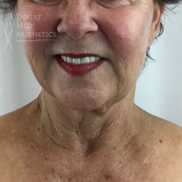 Before full face threads front view case 3