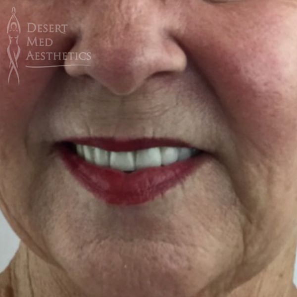 Before full face threads front view closeup case 3