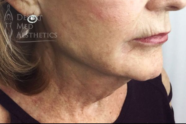 lower face and neck after threads treatment case 1